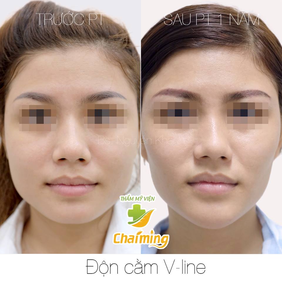 độn cằm