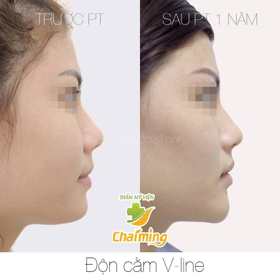 độn cằm