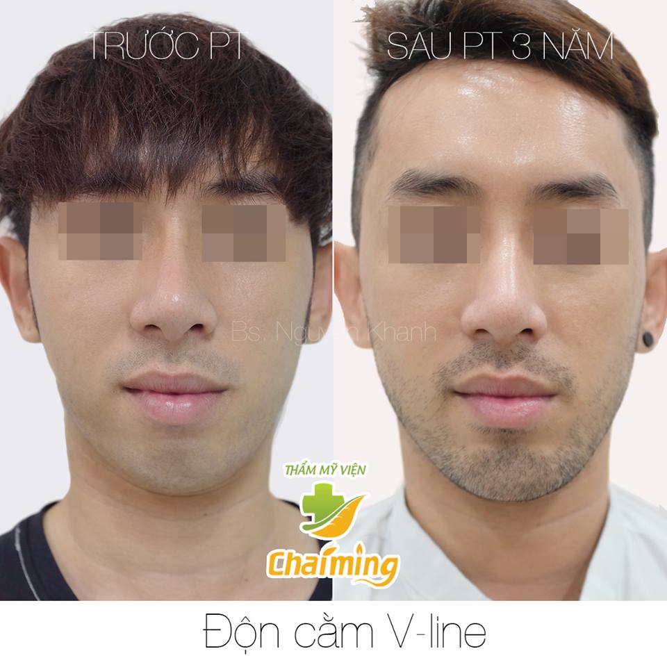 độn cằm