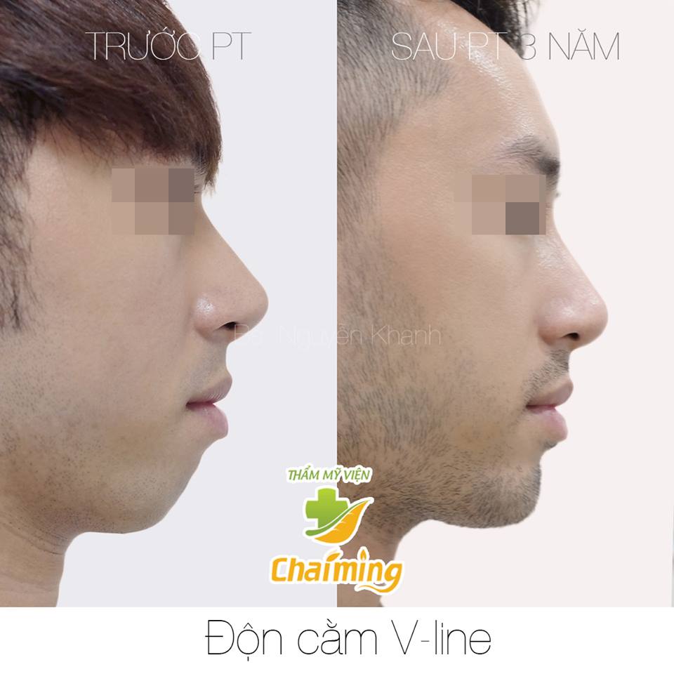 độn cằm