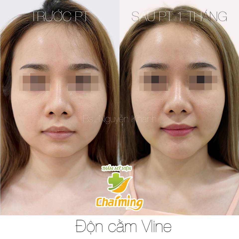độn cằm